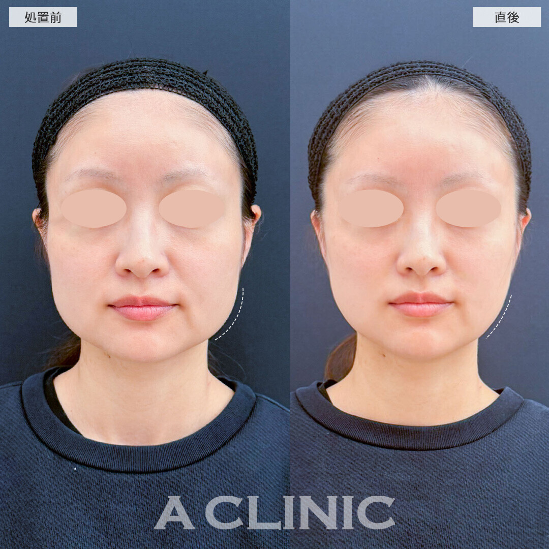 Aスレッドで四角く見える輪郭をなだらかに！こちら処置前と直後の症例です(30代女性)