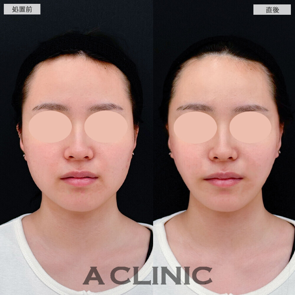 Aスレッドで顔の丸みがリフトアップすることでスッキリしました！こちら処置前と直後の症例です(20代女性)