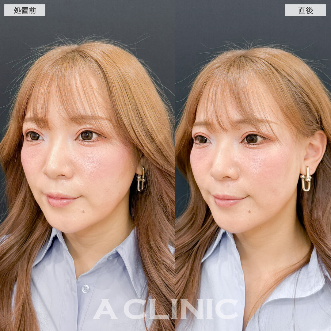 Aスレッドはアンチエイジングのためのメンテナンスに最適です！こちら処置前と直後の症例です(30代女性)