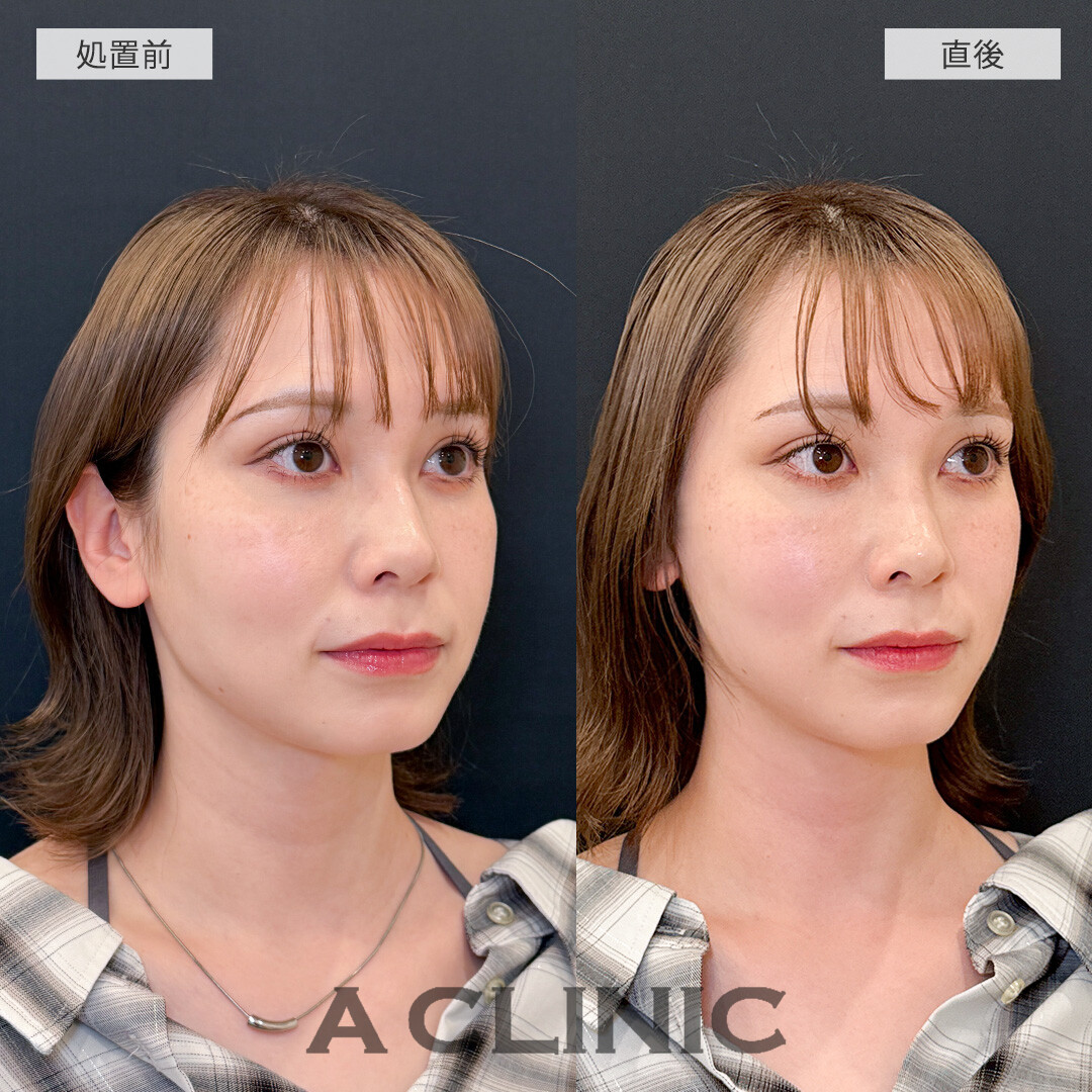 ダウンタイム最小限でたるみを解消してシュッとした輪郭に！Aスレッドの処置前と直後の症例です(30代女性)