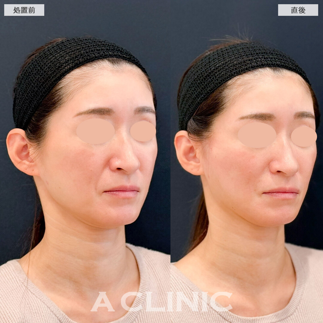 Aスレッドで年齢とともに下がってきたたるみを手軽に引き上げます！こちら処置前と直後の症例です(40代女性)