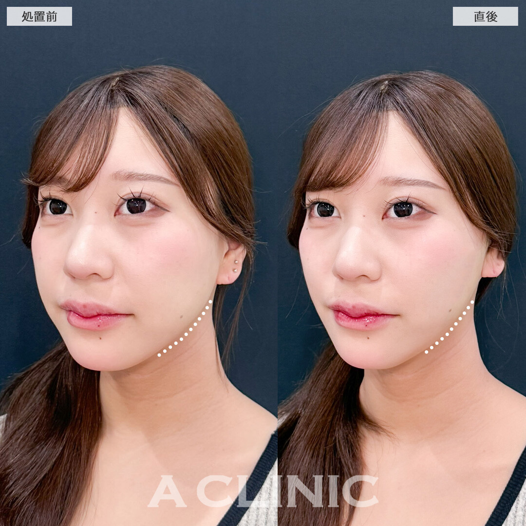 Aスレッドでフェイスラインを整えて自然に垢抜けました！こちら処置前と直後の症例です(20代女性)