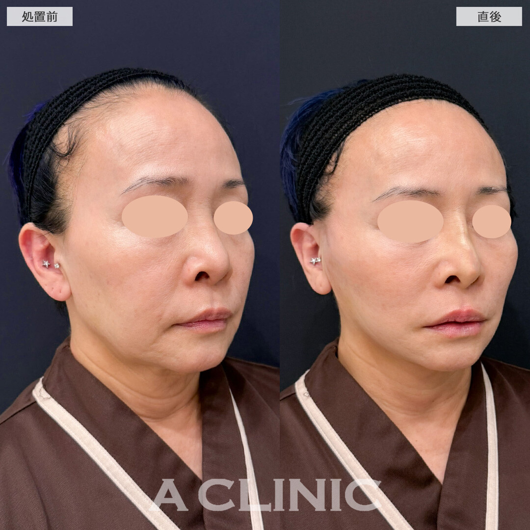 Aスレッドでしっかり引き上げて直後から若返り効果を実感！こちら処置前と直後の症例です(60代女性)