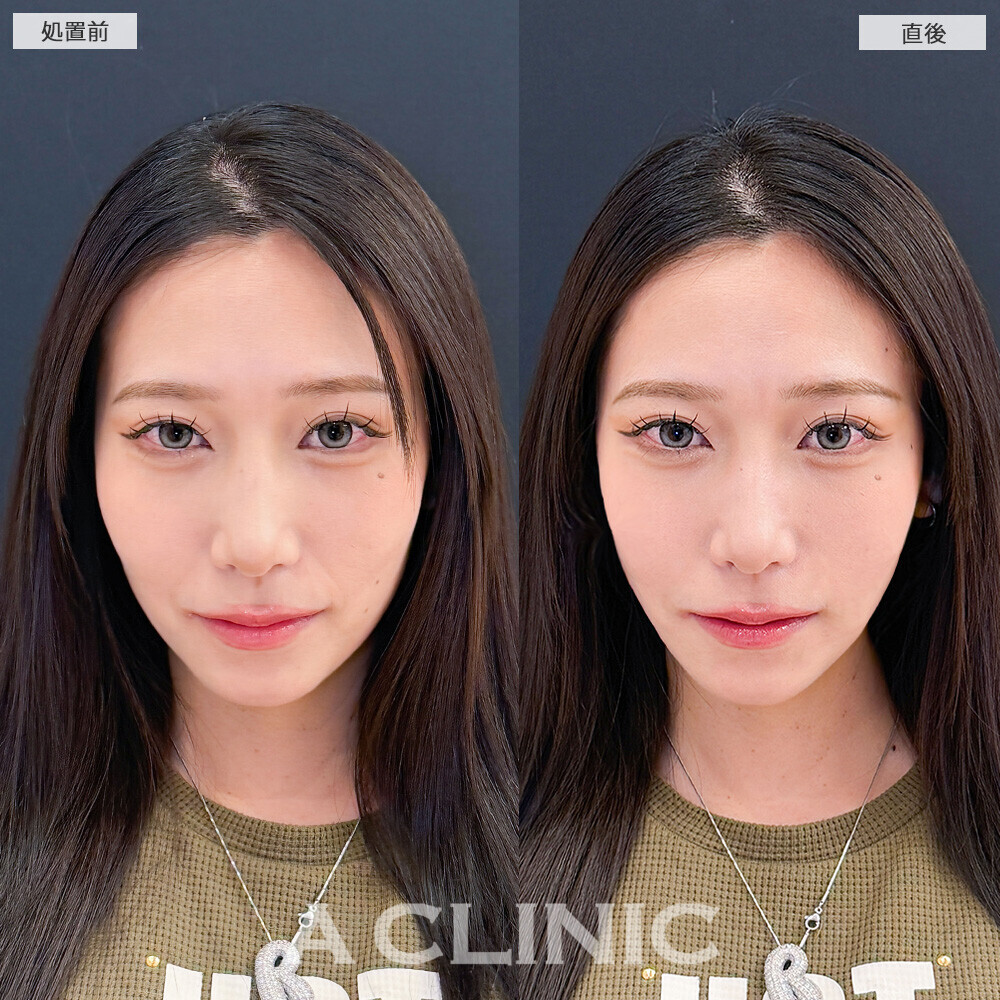 Aスレッドで顔の余白感改善！こちら処置前と直後の症例です(20代女性)