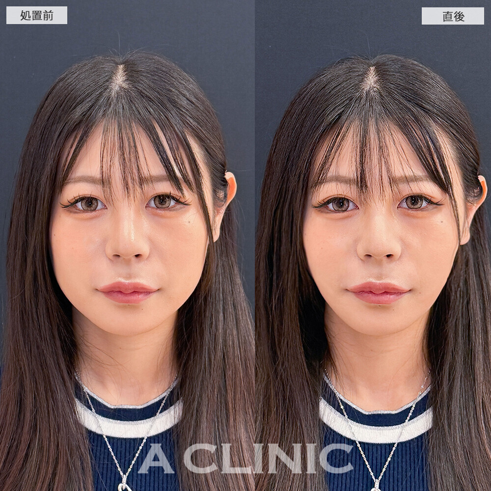 Aスレッドで下膨れ顔が一気にリフトアップ！こちら処置前と直後の症例です(20代女性)