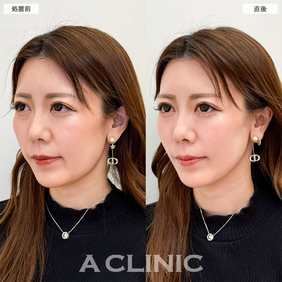Aスレッドでほうれい線や左右差も改善されました！こちら処置前と直後の症例です(30代女性)