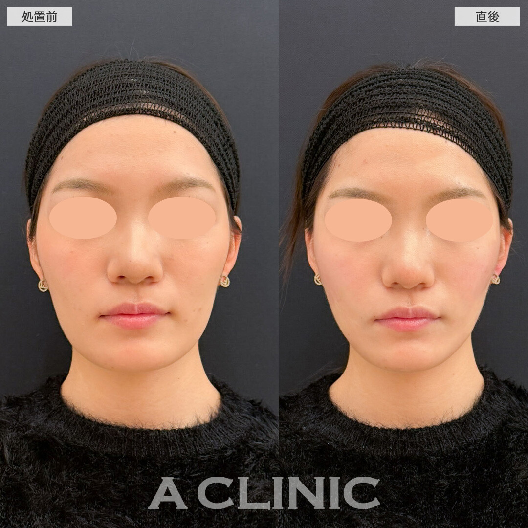 Aスレッドでしっかり引き上げてVフェイスに！こちら処置前と直後の症例です(20代女性)