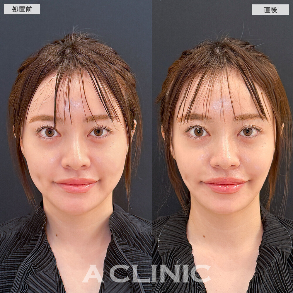 Aスレッドでフェイスラインの左右差や凹凸を改善！こちら処置前と直後の症例です(20代女性)