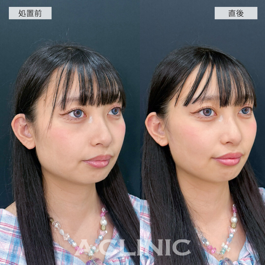 Aスレッドで直後から丸顔改善！こちら処置前と直後の症例です(20代女性)