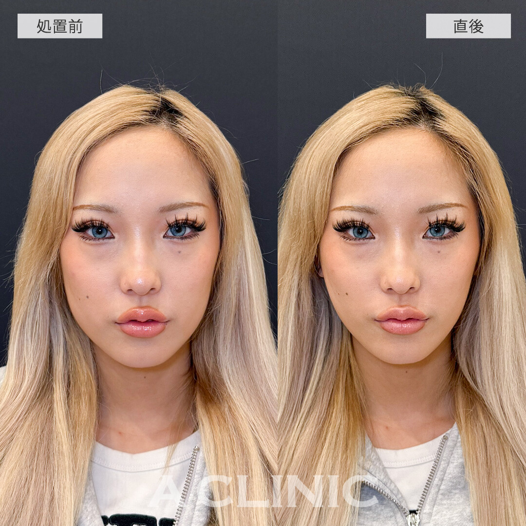 Aスレッドで直後から憧れのVフェイスにアップデート！こちら処置前と直後の症例です(20代女性)