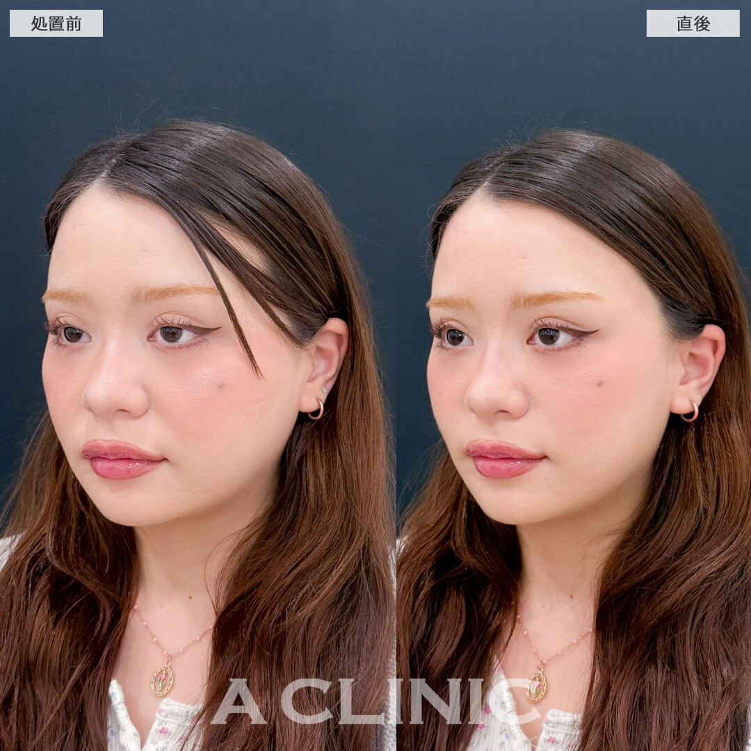 Aスレッドでその日のうちになりたい小顔に！こちら処置前と直後の症例です(20代女性)