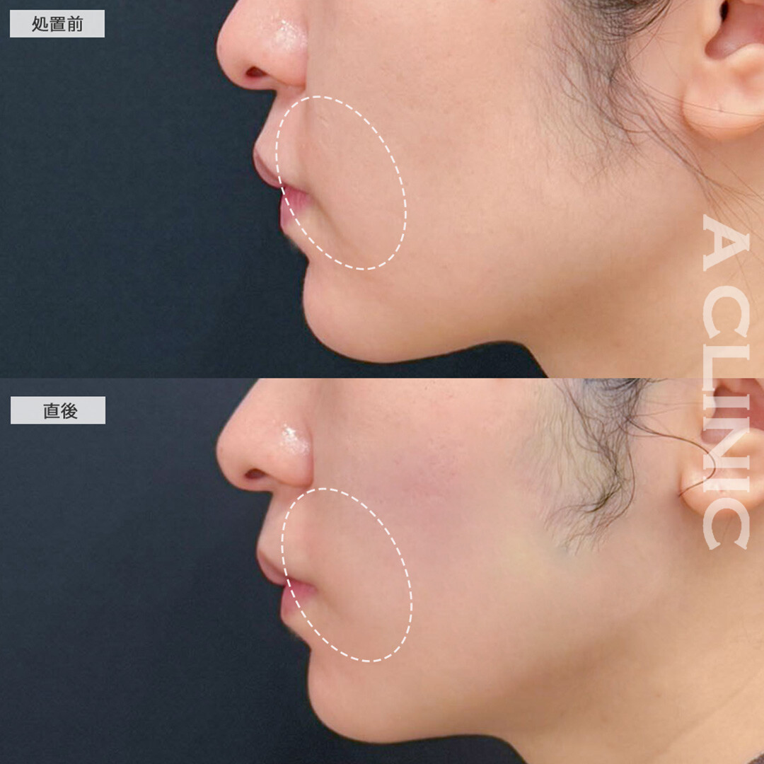 Aスレッドでたるみがナチュラルに引きあがりました！こちら処置前と直後の症例です(20代女性)