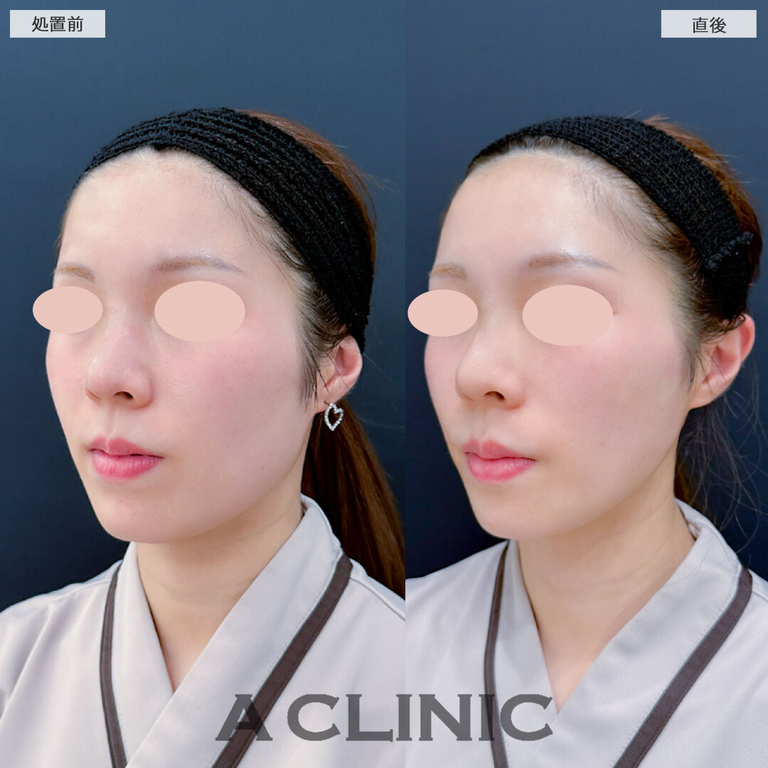 Aスレッドでフェイスラインを引き上げて輪郭がシュッとスッキリしました！こちら処置前と直後の症例です(20代女性)