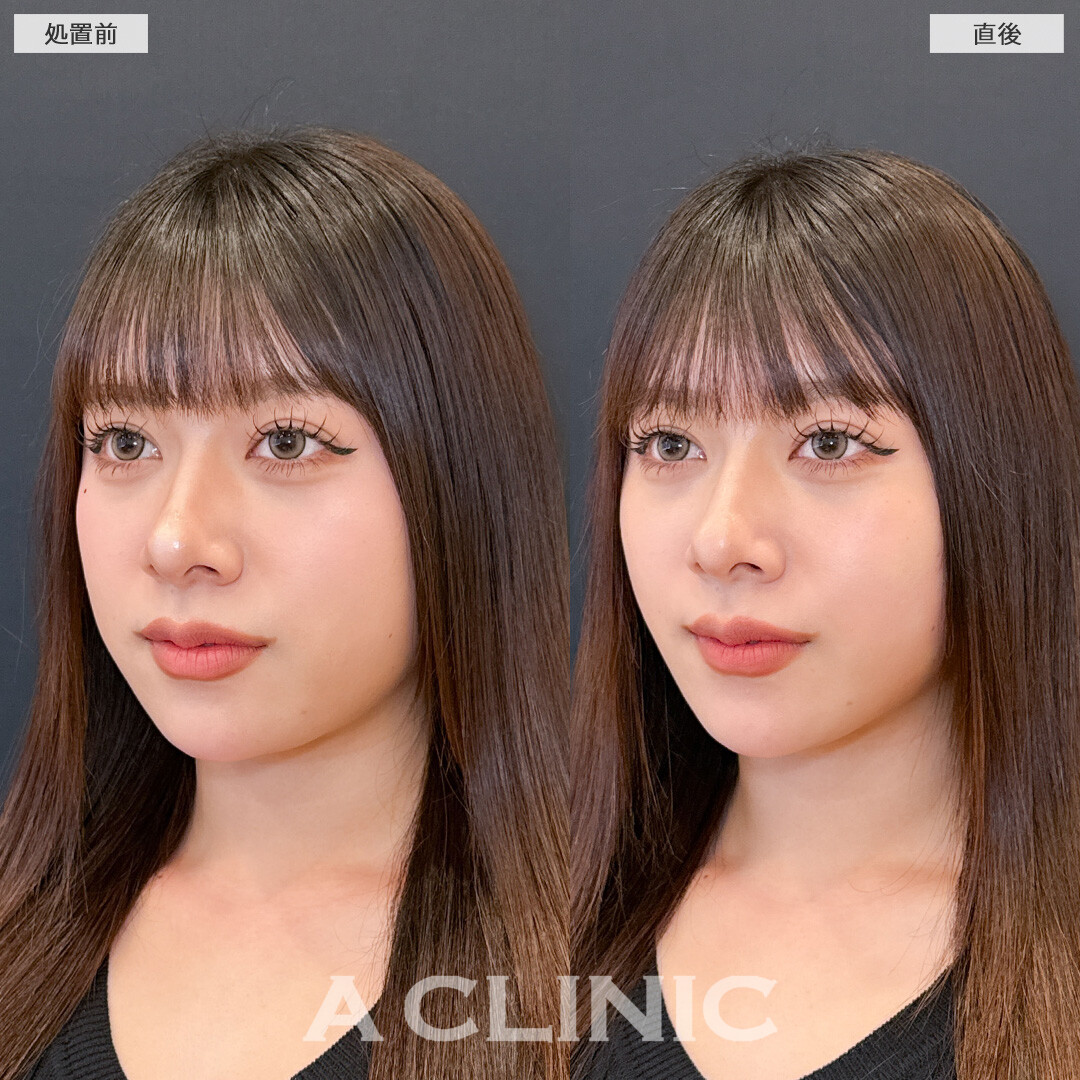 Aスレッドでお顔のもたつき感を減らしてすっきりさせました！こちら処置前と直後の症例です(20代女性)
