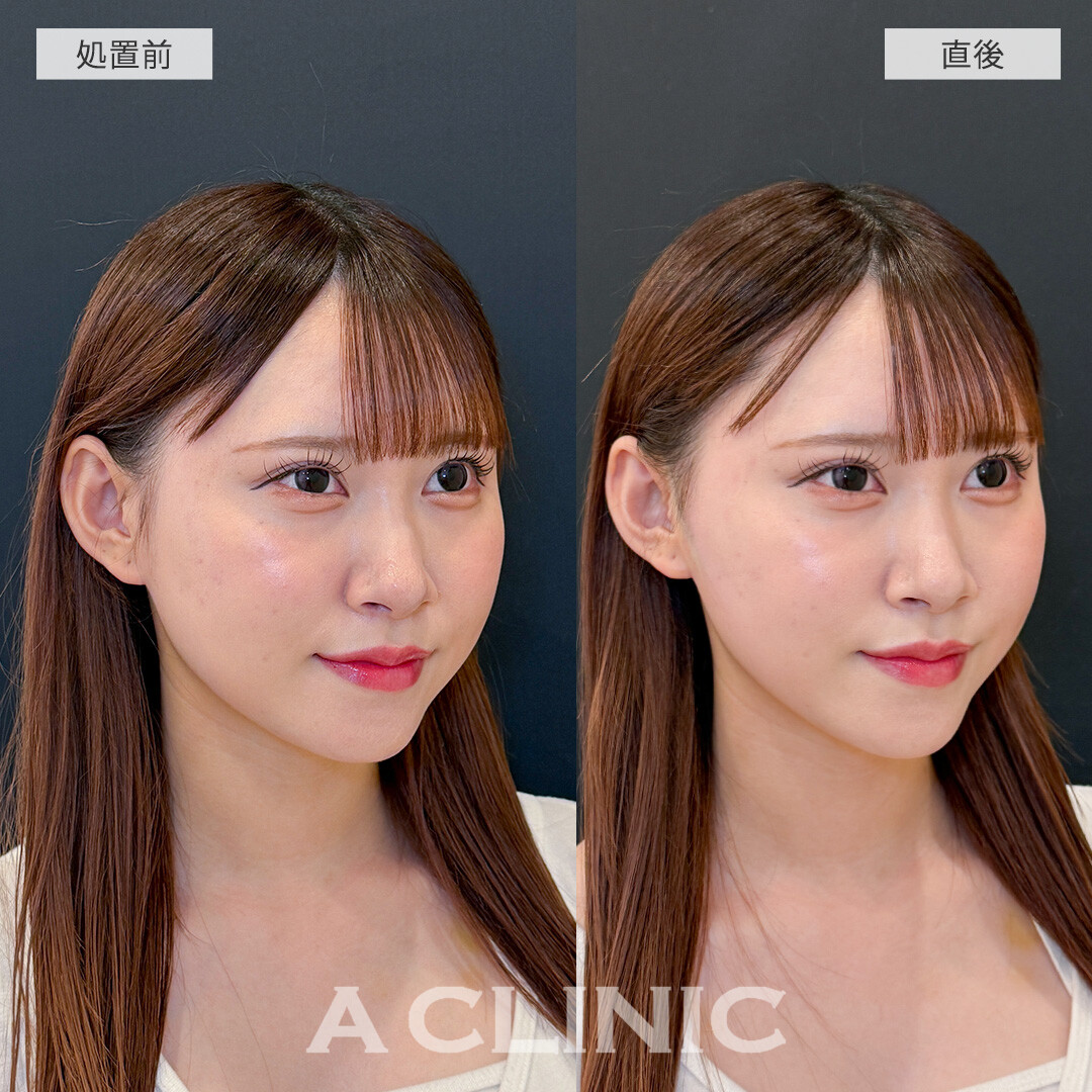 Aスレッドでナチュラルかつしっかりとリフトアップして垢抜け！こちら処置前と直後の症例です(20代女性)