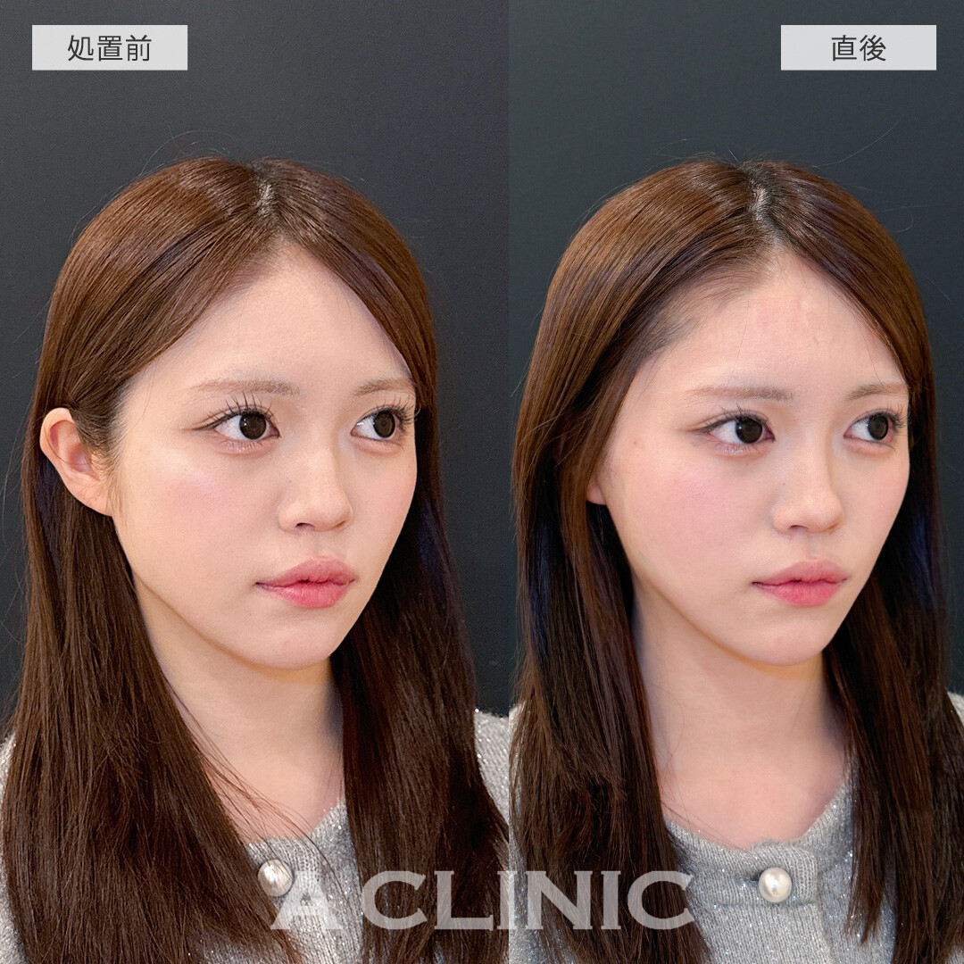 Aスレッドで直後からスッキリした輪郭に大変身！こちら処置前と直後の症例です(20代女性)