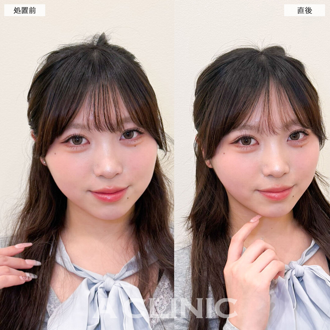 Aスレッドで直後から輪郭スッキリ！こちら処置前と処置直後の症例です(20代女性)