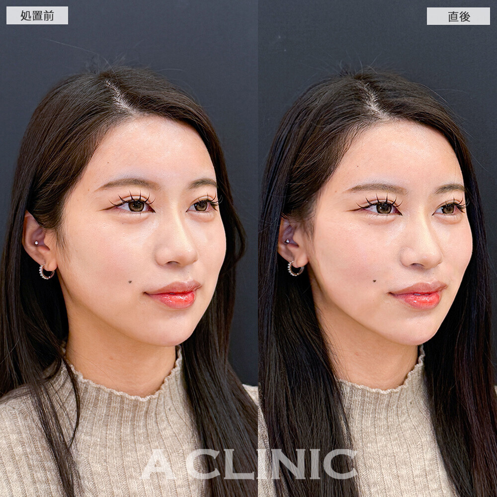 Aスレッドで口横のもたつきがなくなり綺麗な卵型の輪郭に！こちら処置前と直後の症例です(20代女性)