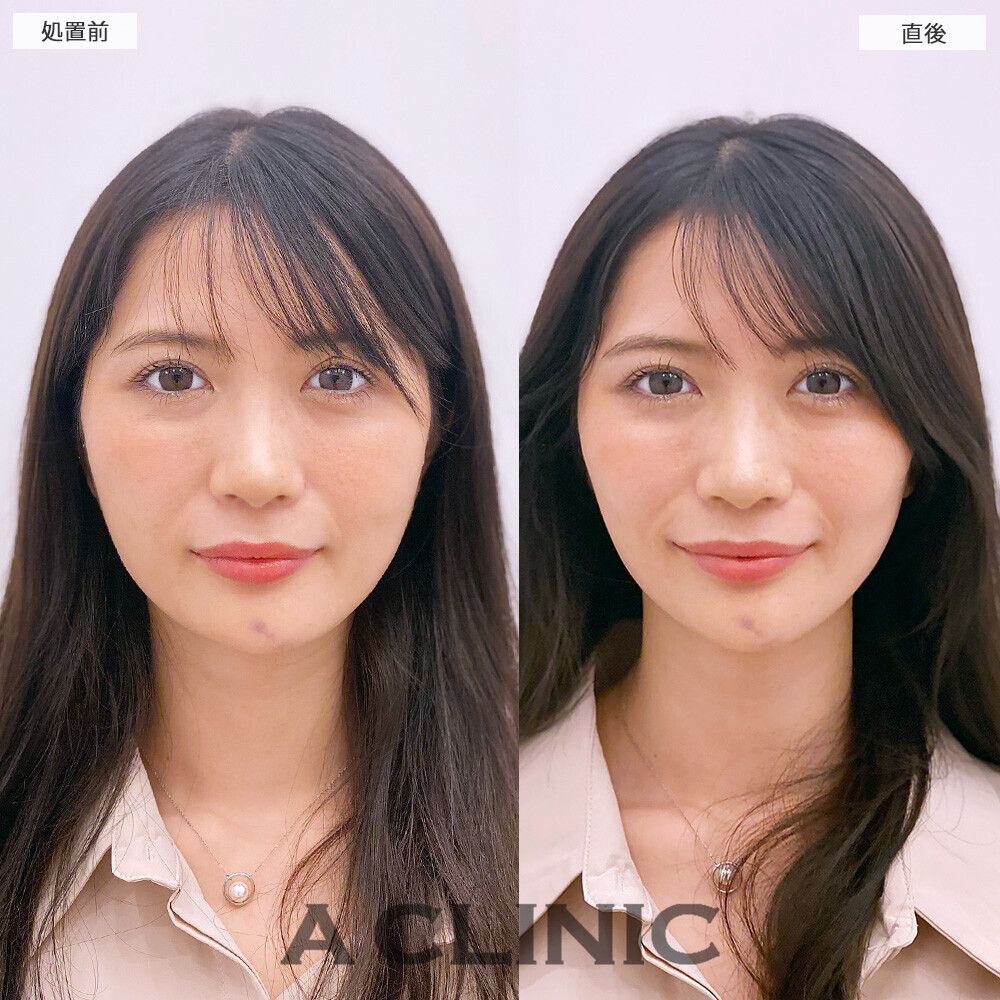 Aスレッドできゅっとリフトアップ！処置前と直後の症例です(20代女性)