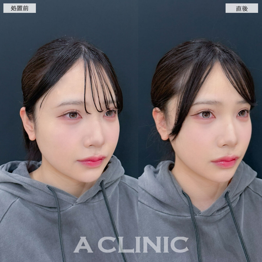 Aスレッドでしっかり引き上げフェイスラインがスッキリしました！こちら処置前と直後の症例です(20代女性)