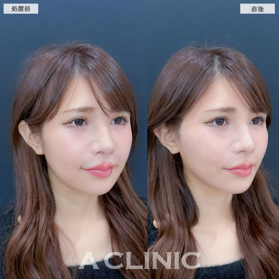 Aスレッドでフェイスラインをしっかり引き上げ直後から理想のVフェイスになりました！こちら処置前と直後の症例です(30代女性)