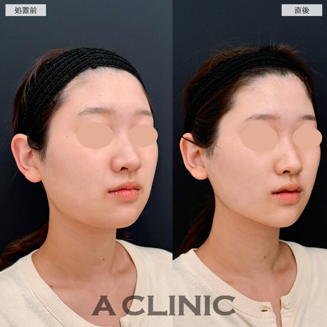 Aスレッドで角張った印象の輪郭が改善！こちら処置前と直後の症例です(20代女性)