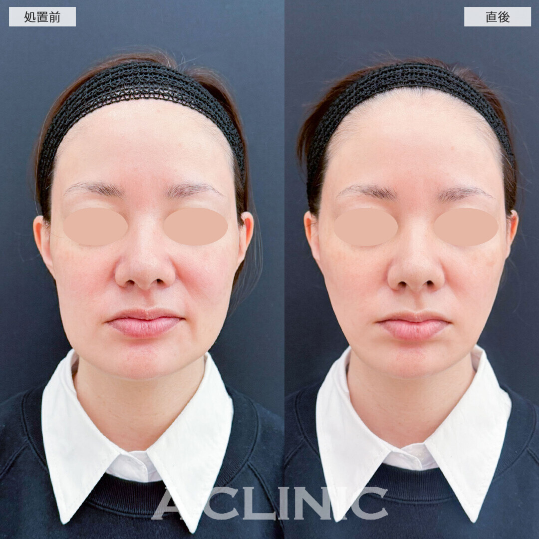 Aスレッドなら腫れや痛み最小限でしっかり小顔に！こちら処置前と直後の症例です(40代女性)