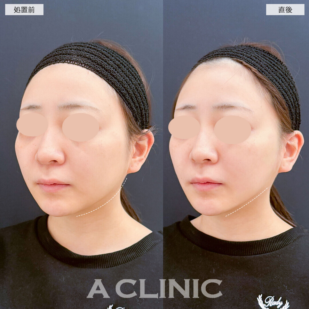 Aスレッドのリフトアップ効果とほうれい線改善で若返り！こちら処置前と直後の症例です(20代女性)