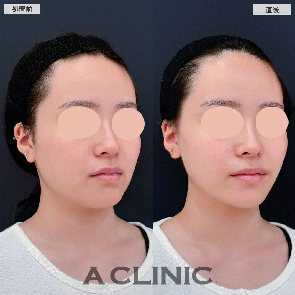 Aスレッドで顔の丸みがリフトアップすることでスッキリしました！こちら処置前と直後の症例です(20代女性)