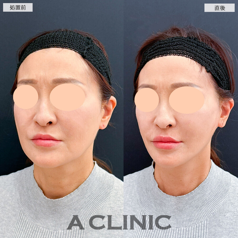 Aスレッドでたるみが引き上がりました！こちら処置前と直後の症例です(50代女性)