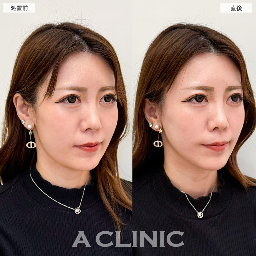 Aスレッドでほうれい線や左右差も改善されました！こちら処置前と直後の症例です(30代女性)