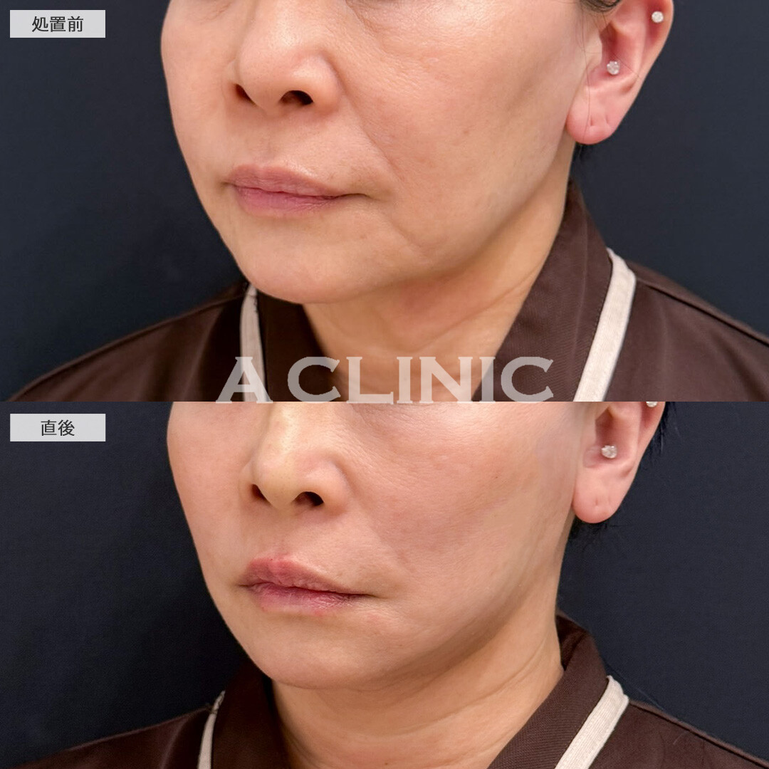 Aスレッドでしっかり引き上げて直後から若返り効果を実感！こちら処置前と直後の症例です(60代女性)