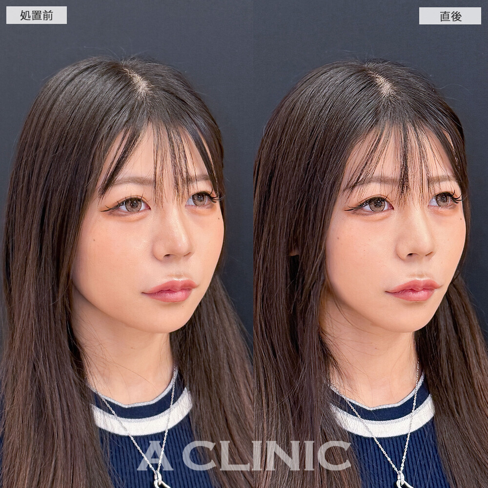 Aスレッドで下膨れ顔が一気にリフトアップ！こちら処置前と直後の症例です(20代女性)