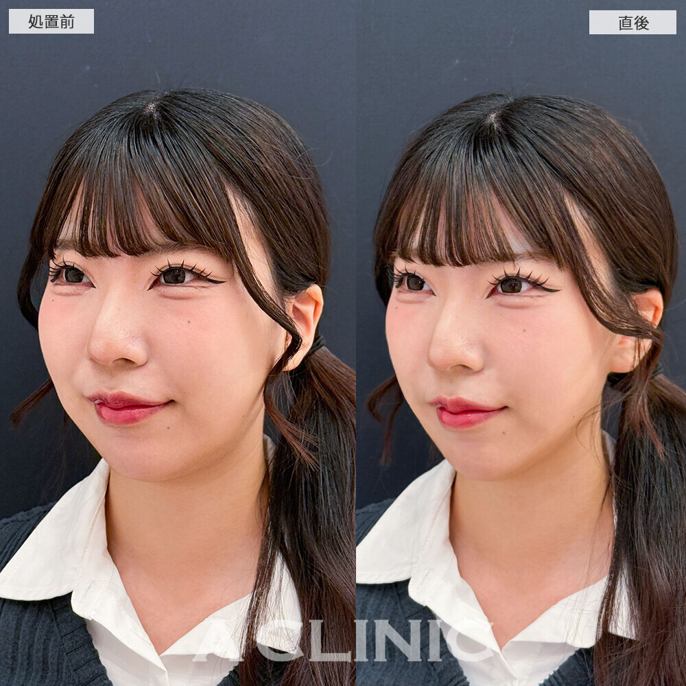 Aスレッドで口横のもたつきスッキリ！こちら処置前と直後の症例です(20代女性)