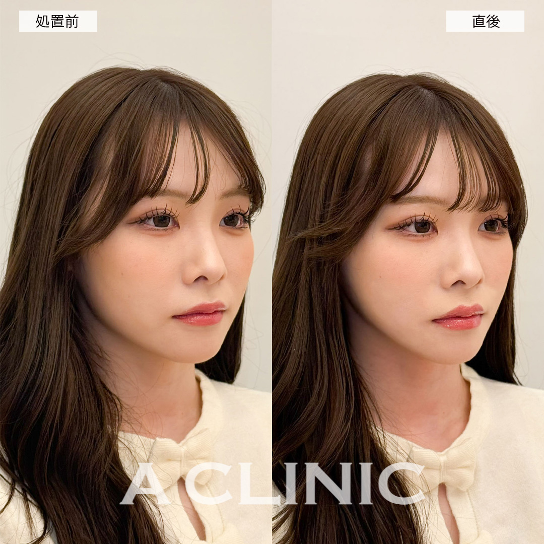 Aスレッドで左右差のない美しいファイスラインに！こちら処置前と直後の症例です(20代女性)
