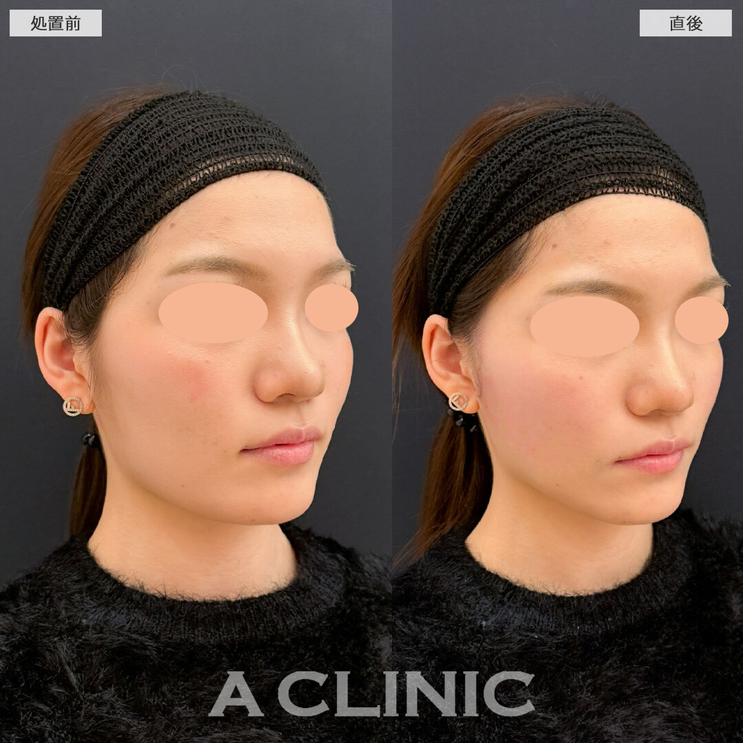 Aスレッドでしっかり引き上げてVフェイスに！こちら処置前と直後の症例です(20代女性)