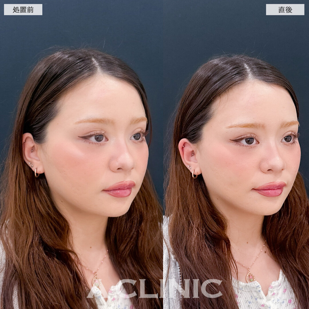 Aスレッドでその日のうちになりたい小顔に！こちら処置前と直後の症例です(20代女性)