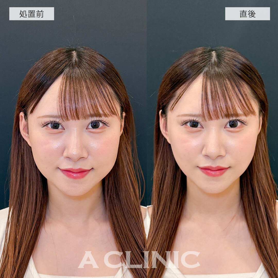 Aスレッドでナチュラルかつしっかりとリフトアップして垢抜け！こちら処置前と直後の症例です(20代女性)
