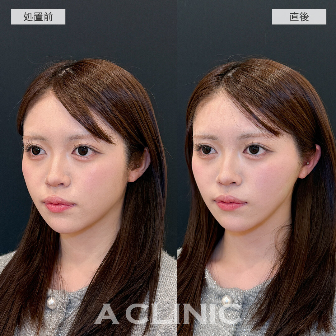 Aスレッドで直後からスッキリした輪郭に大変身！こちら処置前と直後の症例です(20代女性)