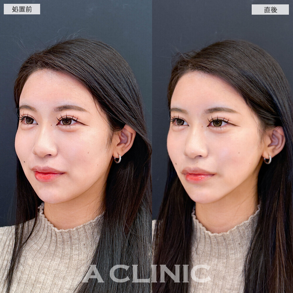 Aスレッドで口横のもたつきがなくなり綺麗な卵型の輪郭に！こちら処置前と直後の症例です(20代女性)