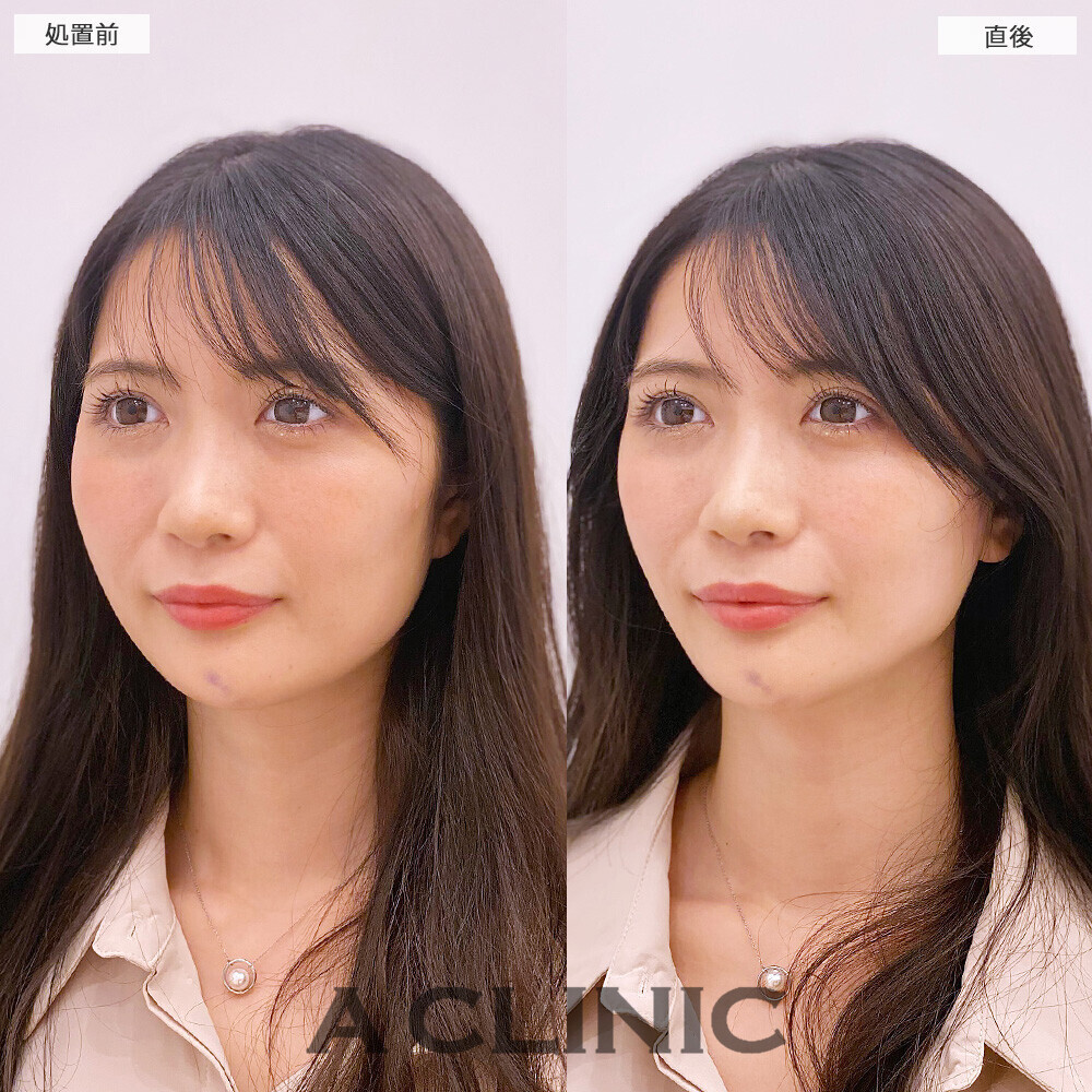 Aスレッドできゅっとリフトアップ！処置前と直後の症例です(20代女性)