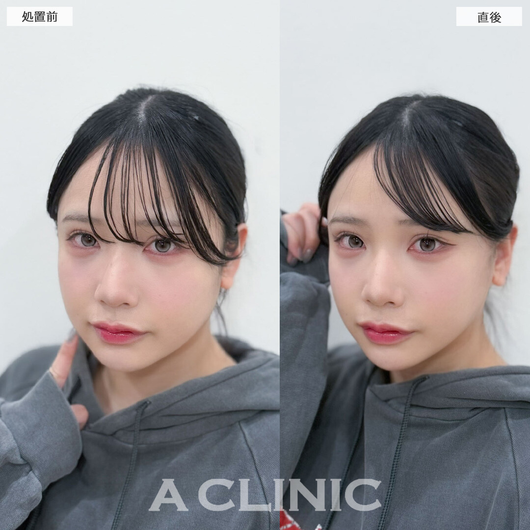 Aスレッドでしっかり引き上げフェイスラインがスッキリしました！こちら処置前と直後の症例です(20代女性)
