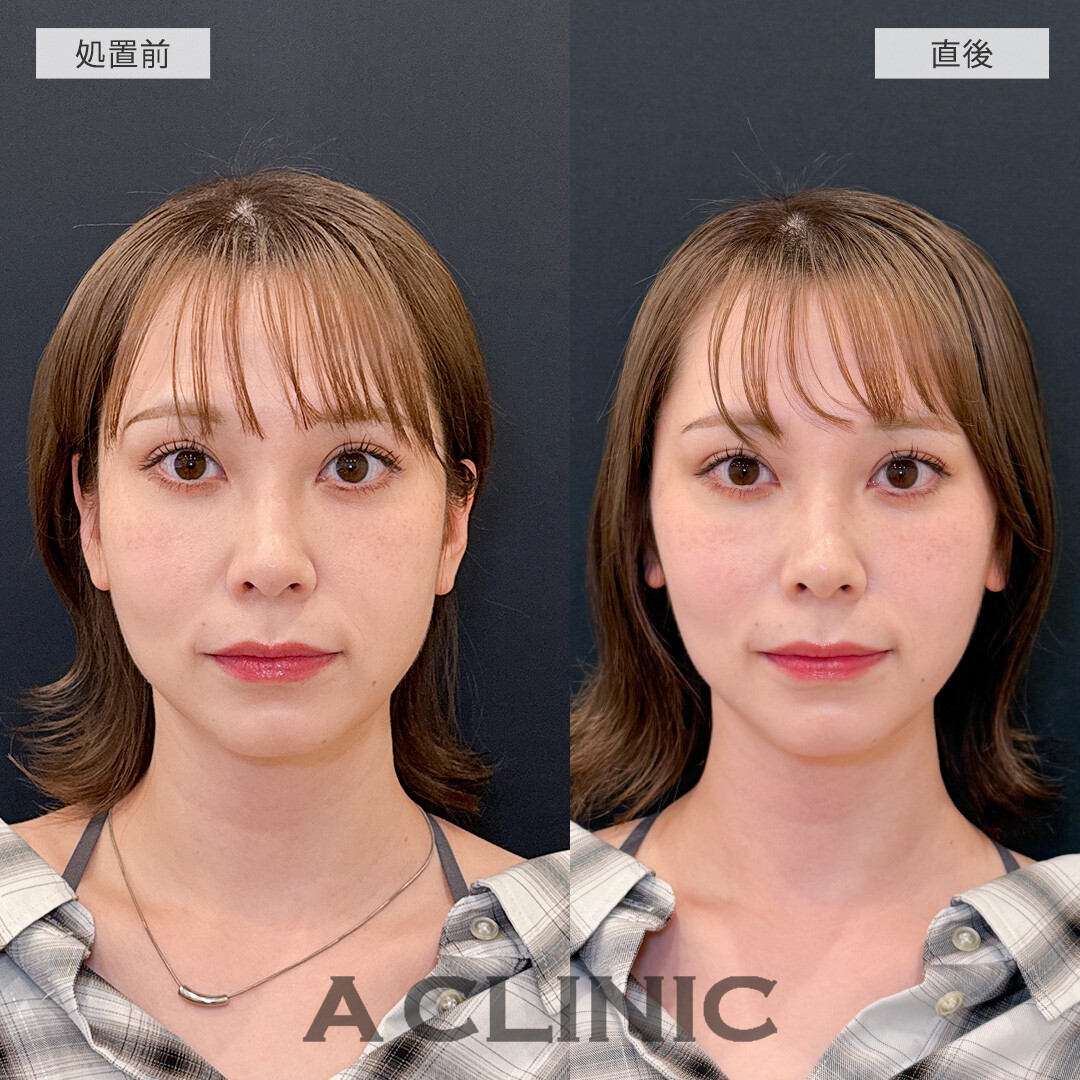 ダウンタイム最小限でたるみを解消してシュッとした輪郭に！Aスレッドの処置前と直後の症例です(30代女性)