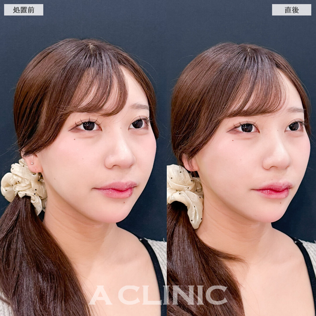 Aスレッドでフェイスラインを整えて自然に垢抜けました！こちら処置前と直後の症例です(20代女性)