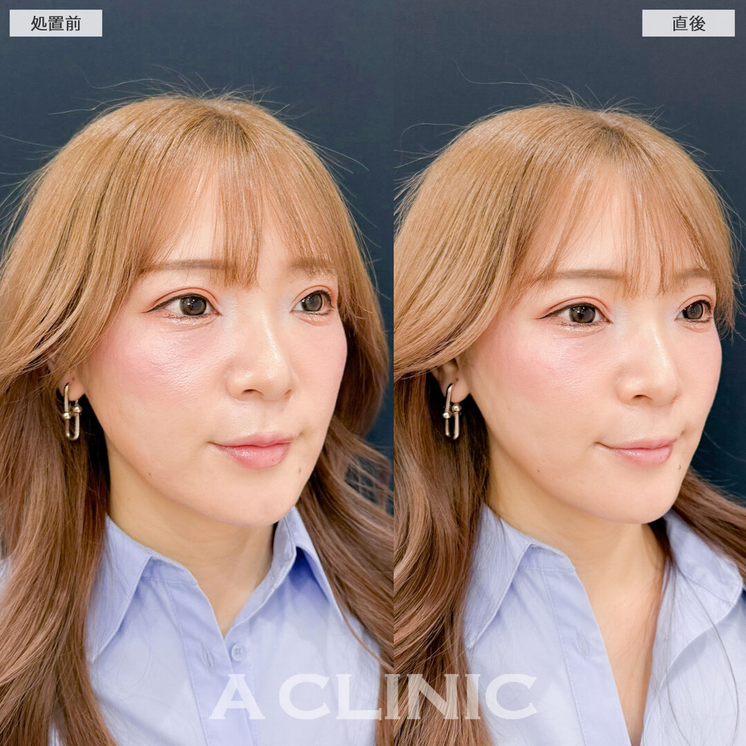 Aスレッドはアンチエイジングのためのメンテナンスに最適です！こちら処置前と直後の症例です(30代女性)