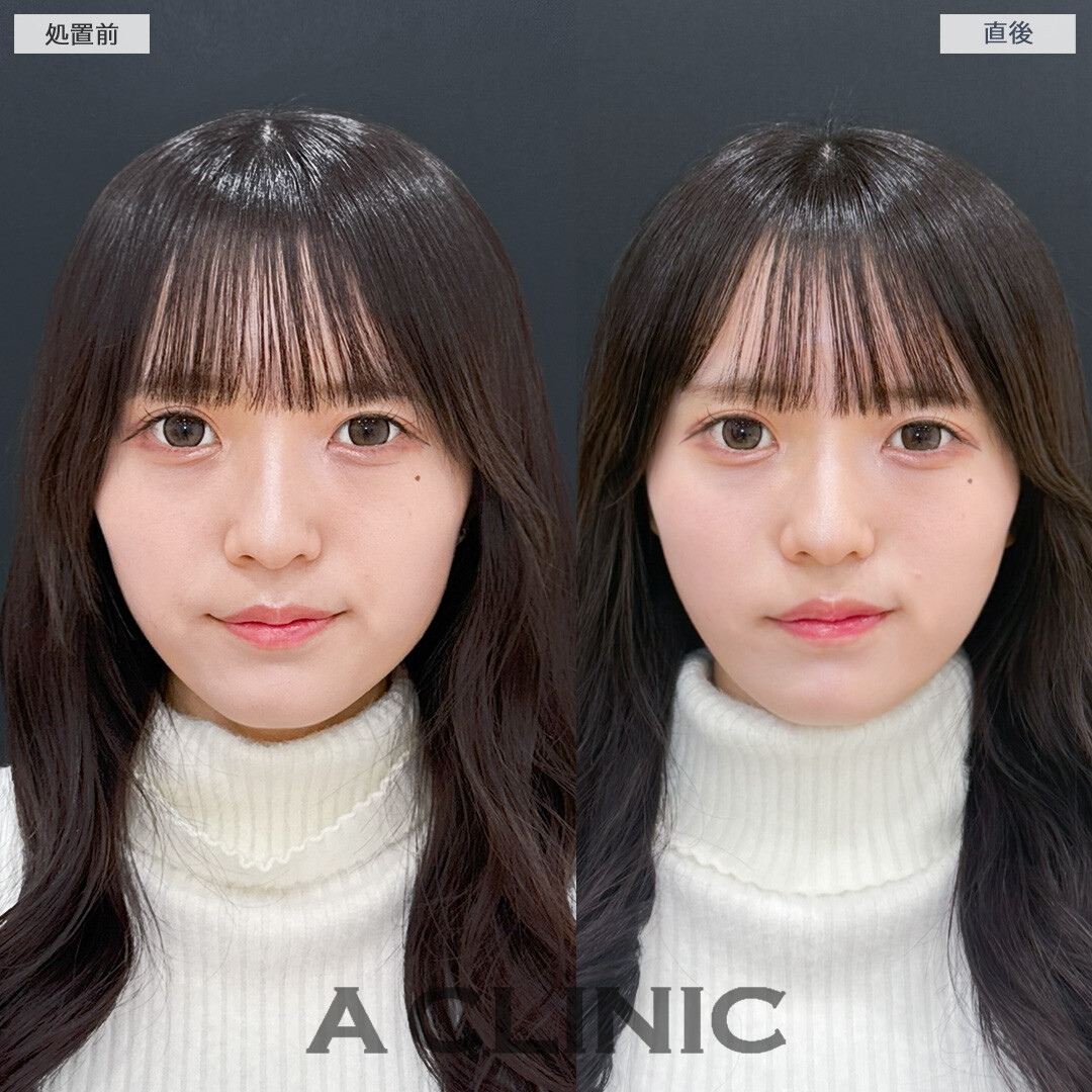Aスレッドで気になる部分を引き上げてお悩み解消できました！処置前と直後の症例です(20代女性)