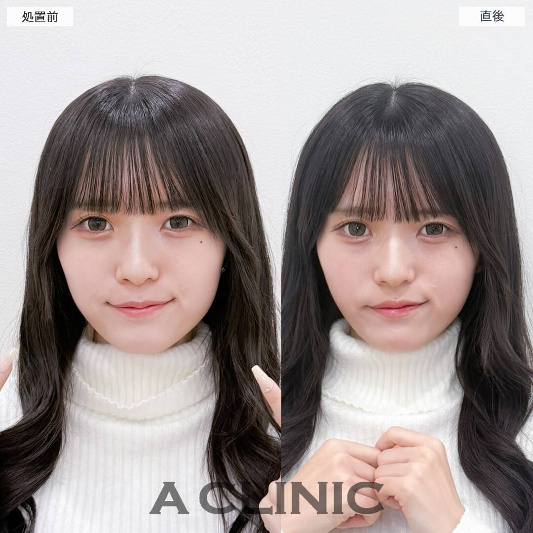 Aスレッドで気になる部分を引き上げてお悩み解消できました！処置前と直後の症例です(20代女性)