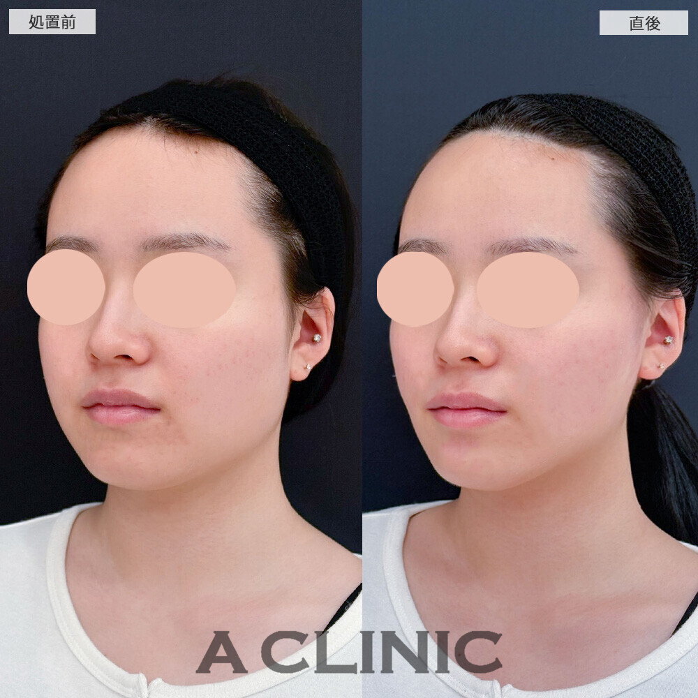 Aスレッドで顔の丸みがリフトアップすることでスッキリしました！こちら処置前と直後の症例です(20代女性)