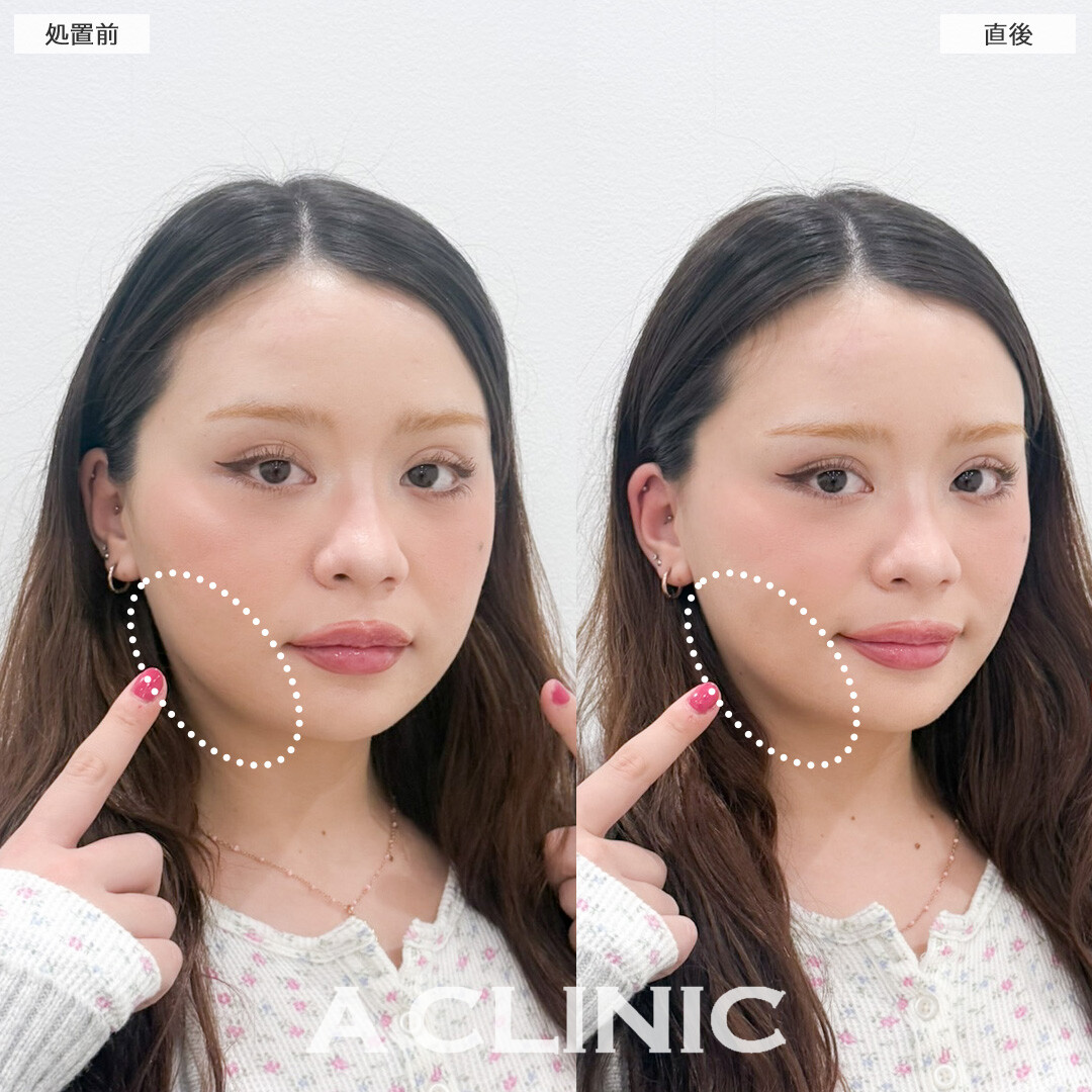 Aスレッドでその日のうちになりたい小顔に！こちら処置前と直後の症例です(20代女性)