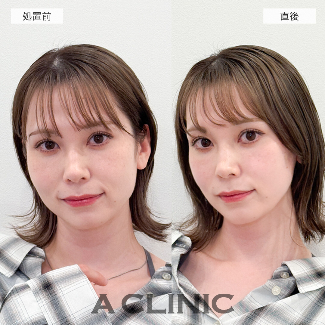 ダウンタイム最小限でたるみを解消してシュッとした輪郭に！Aスレッドの処置前と直後の症例です(30代女性)